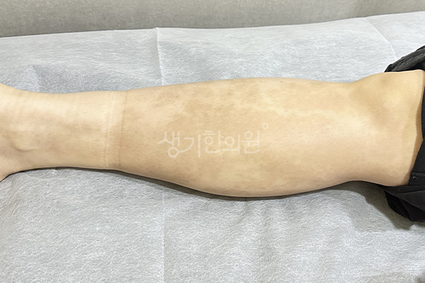 생기한의원 건선 치료 후 개선 사진