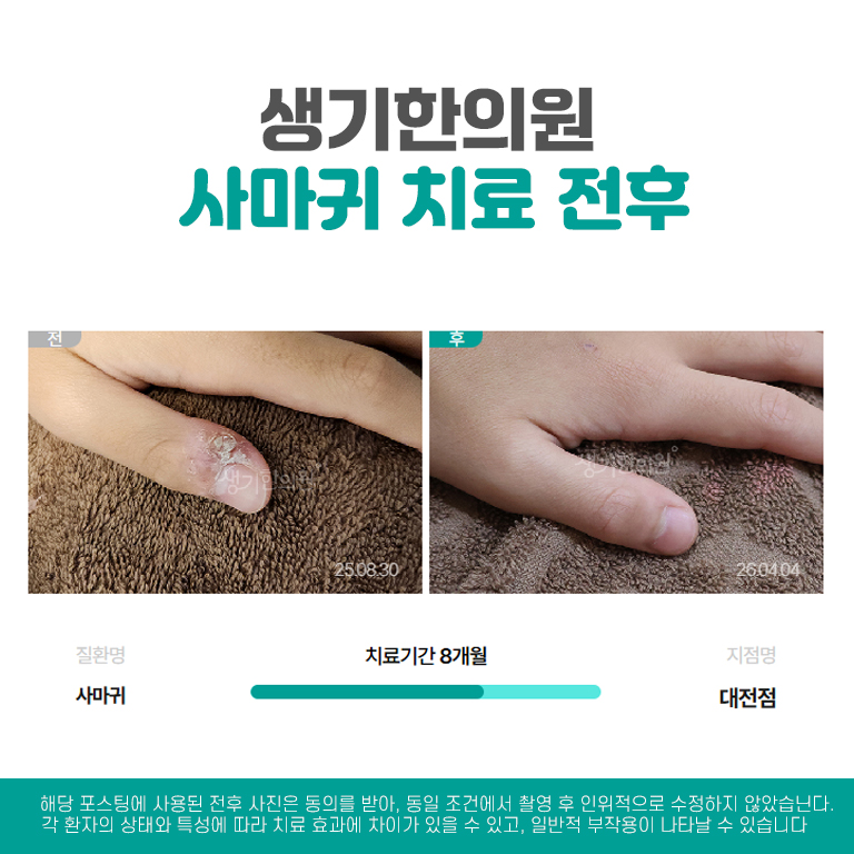 %25EB%258C%2580%25EC%25A0%2584%25EC%2582%25AC%25EB%25A7%2588%25EA%25B7%2580%25EC%25B9%2598%25EB%25A3%258C%25EC%25A0%2584%25ED%259B%2584.jpg
