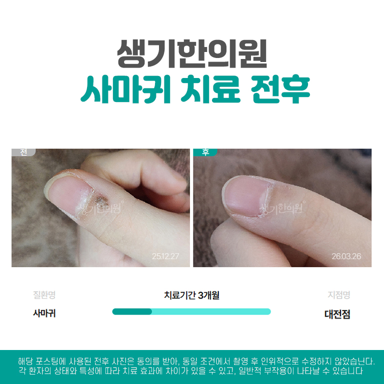%25EB%258C%2580%25EC%25A0%2584%25EC%2582%25AC%25EB%25A7%2588%25EA%25B7%2580%25EC%25B9%2598%25EB%25A3%258C%25EC%25A0%2584%25ED%259B%25843.jpg