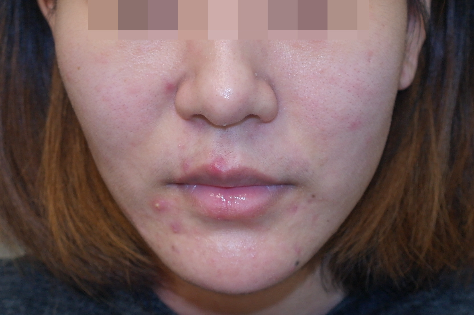 얼굴의 모낭염 관련 자료. 첫 사진과 다른 자료이며, 원인과 치료는 사진만으로 정하지 않아요.