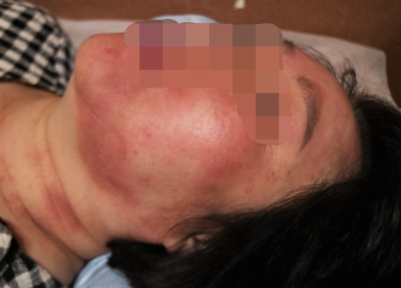 얼굴의 지루성피부염 관련 자료. 첫 사진과 다른 자료이며 특정 화장품의 사용 결과나 치료 전후 비교가 아닙니다.