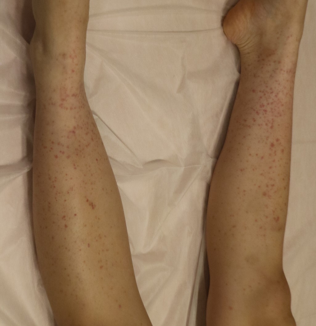 다른 자료의 다리 자반 양상. 첫 사진과 치료 전후 관계가 없으며, 진찰과 동반 증상을 함께 평가해야 해요.