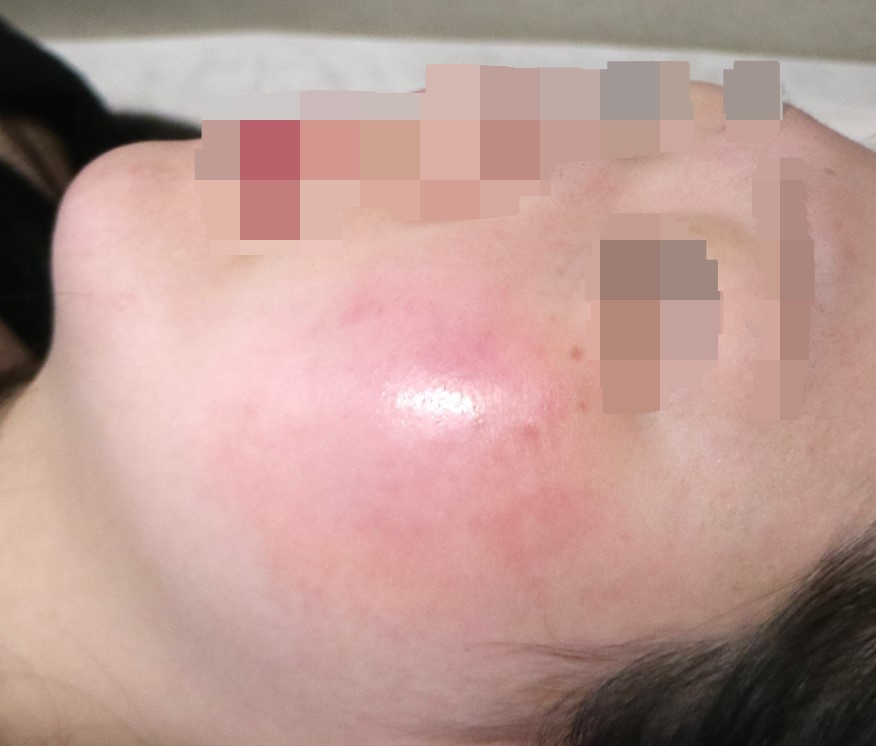 볼 부위가 붉어지고 부은 모습