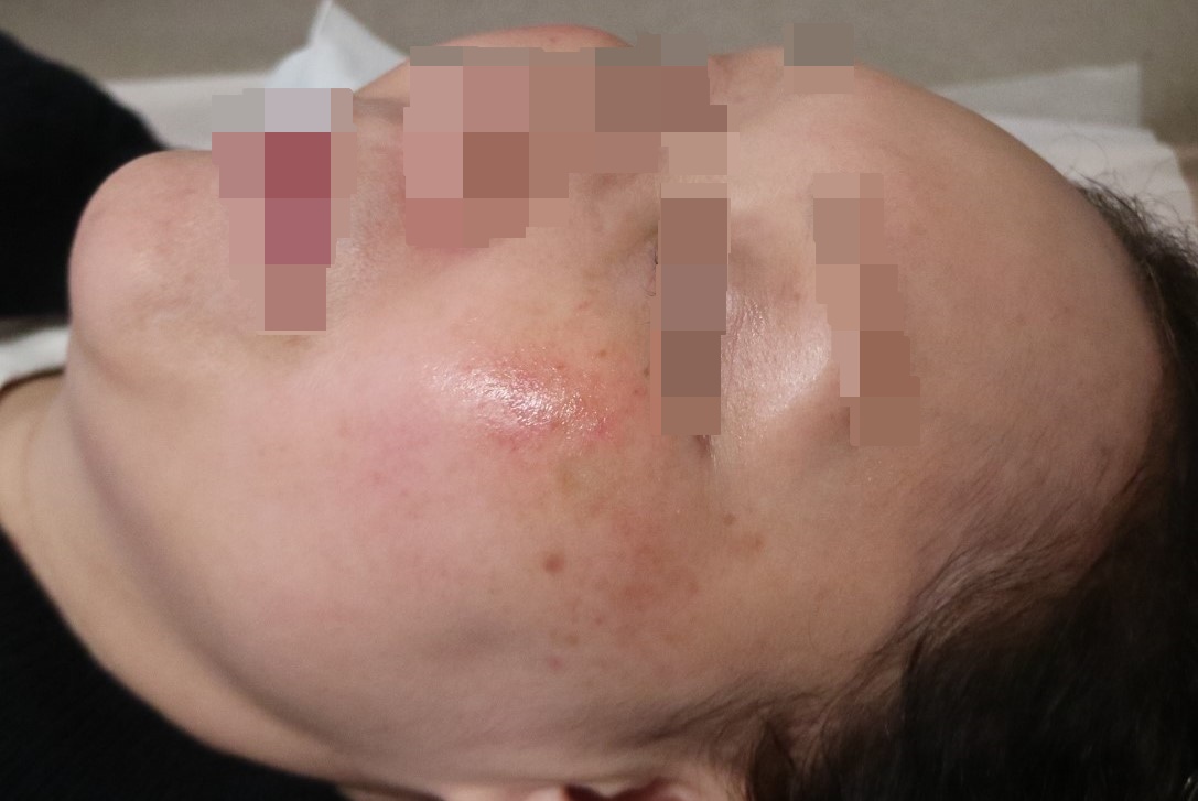 볼과 코 주변의 붉음과 작은 돌기