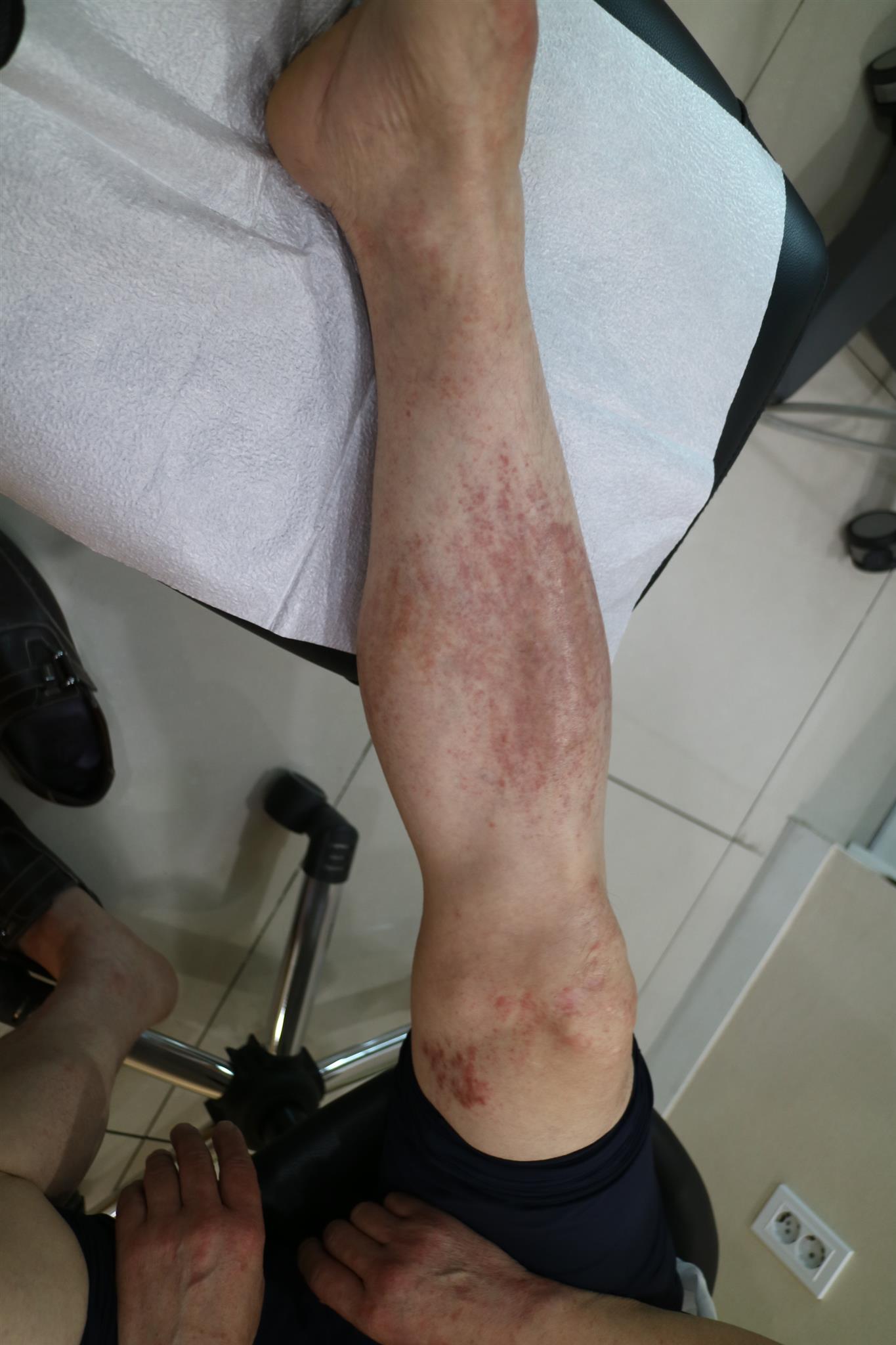 다리의 피부 변화가 동반된 가려움 자료