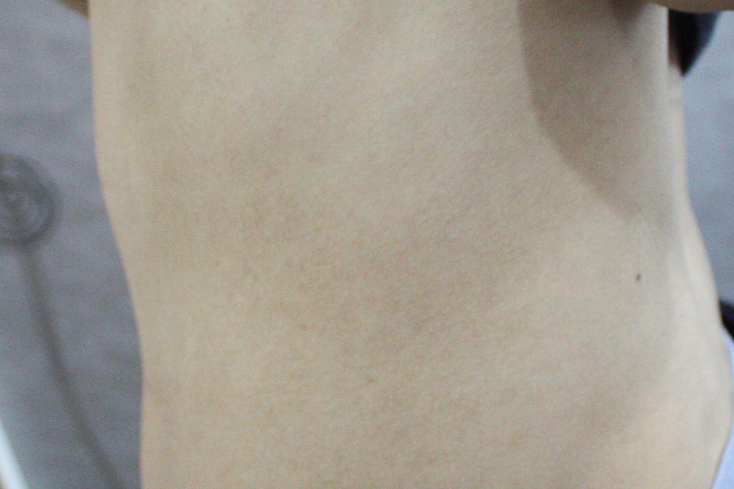 습진 치료 후 사진 · 치료기간 5개월 · 생기한의원 청주점