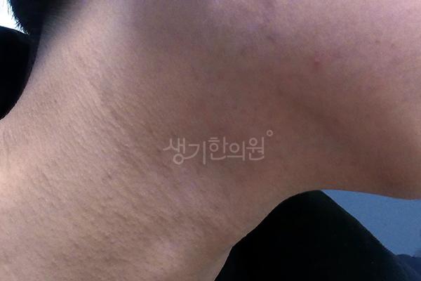 모낭염 치료 후 사진 · 치료기간 4개월 · 생기한의원 청주점