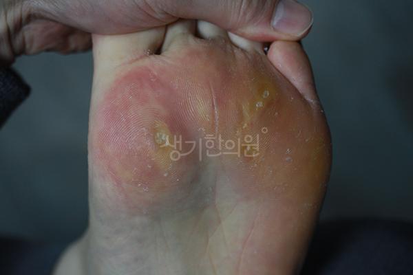 사마귀 치료 전 사진 · 생기한의원 청주점