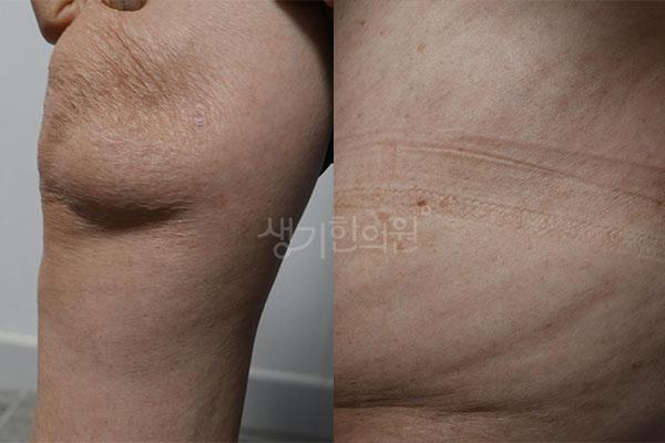 건선 치료 후 사진 · 치료기간 10개월 · 생기한의원 청주점