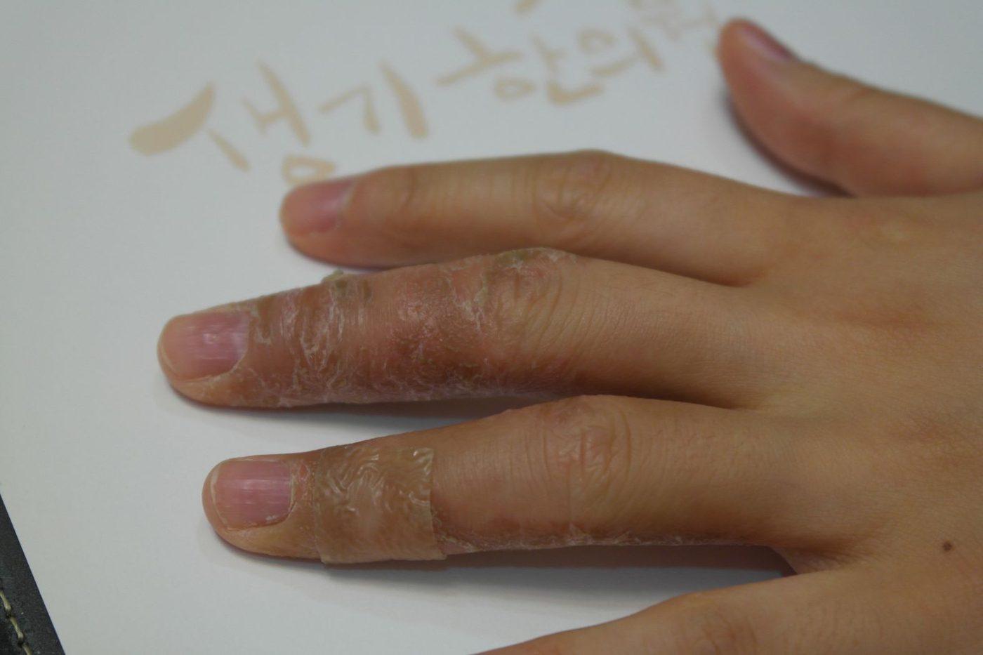 손가락과 손등의 각질 및 붉은 피부 변화가 보이는 습진 자료사진