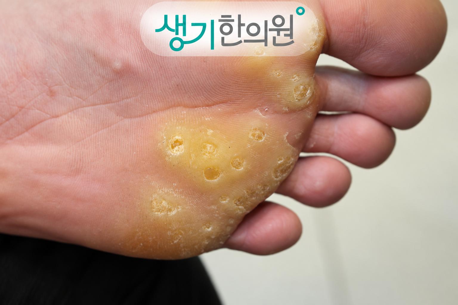 증상 참고 사진 위에 로고를 배치한 썸네일