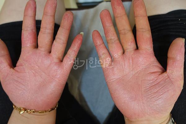 치료 전 공개 사례 원본 사진